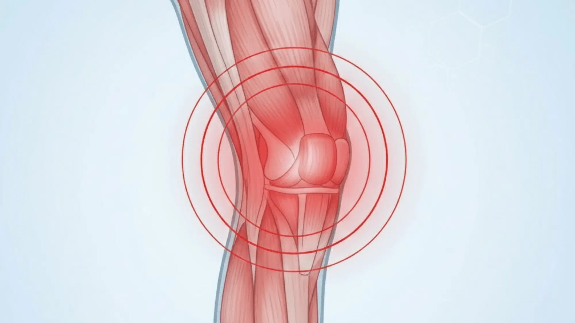 muscle imbalances that trigger knee pain