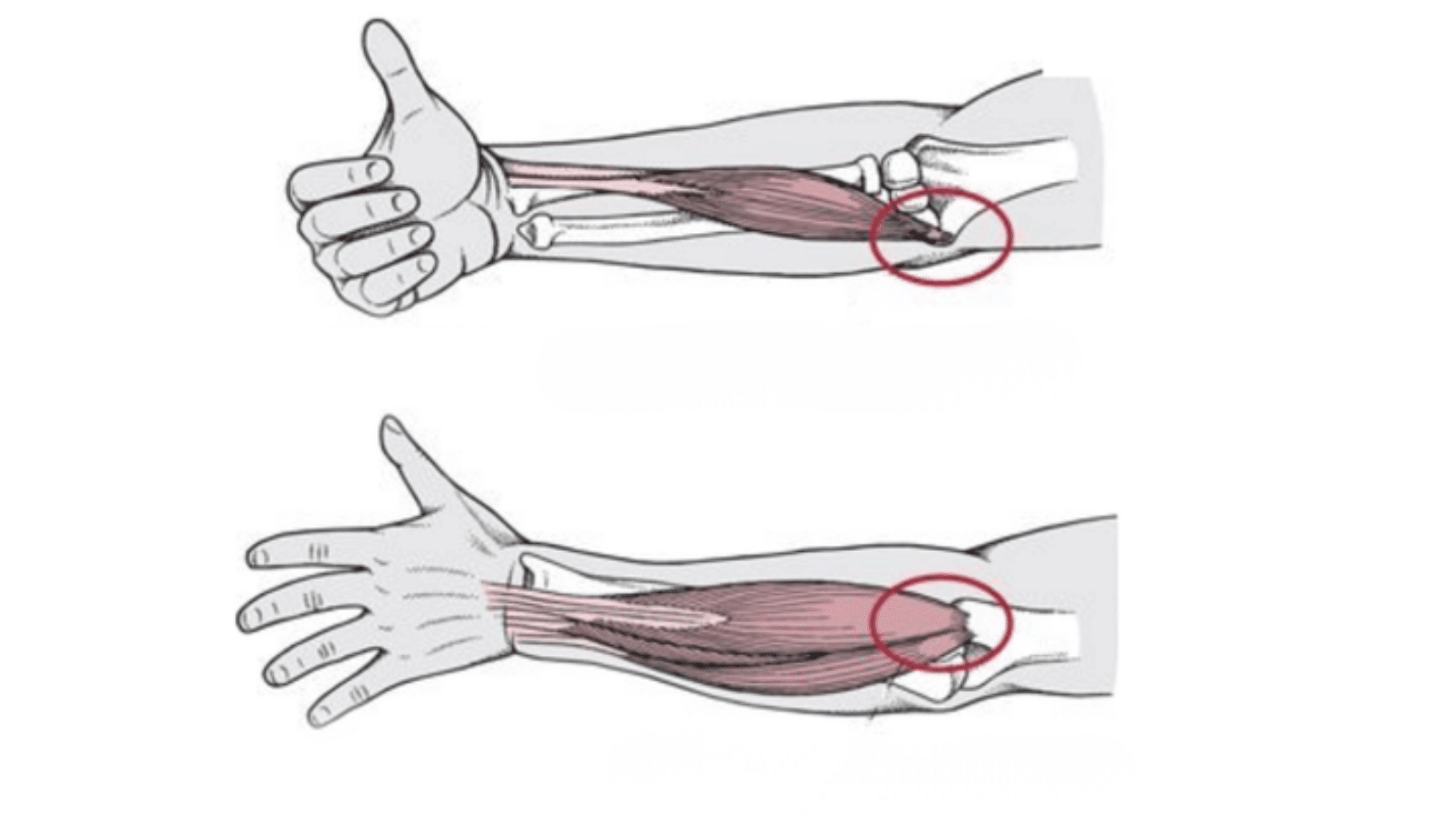 golfers elbow vs tennis elbow key differences