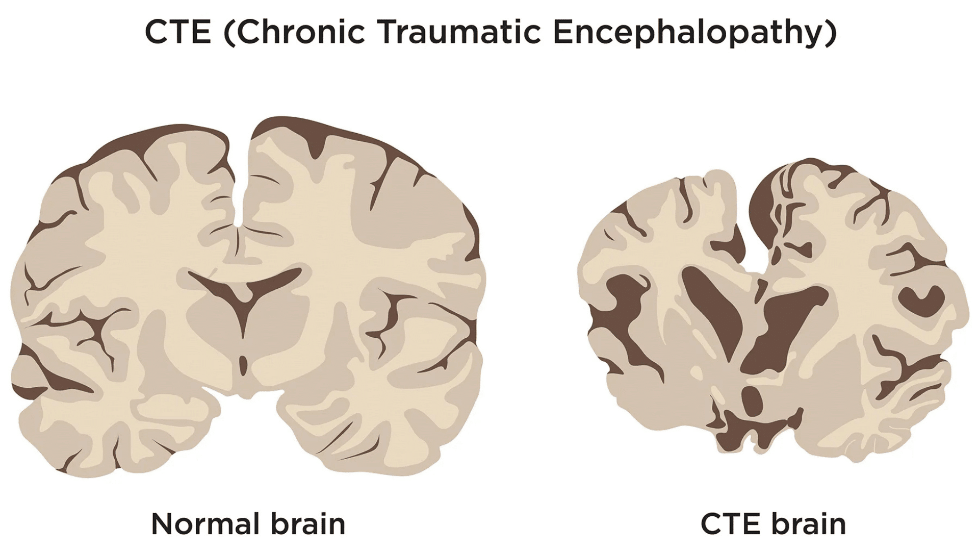 illustration comparing a normal brain with a smaller cte brain showing enlarged spaces and reduced brain tissue